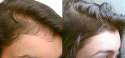 Woman treated with Hair Loss Treatment - Woman treated with Hair Loss Treatment through Theradome Low Level Light Therapy