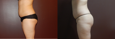 25-34 year old woman treated with Weight Loss - 30 year old woman used Ultraslim for weight loss, fat reduction, body contouring, and skin tightening. 3 treatments.