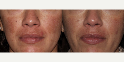35-44 year old woman treated with Laser Genesis, Excel V, DiamondGlow - Patient was treated for sun damage, rosacea and acne using 2 different lasers (Excel V & Genesis), and finishing with a DiamondGlow Facial.