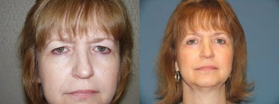 Endoscopic browlift, Upper and Lower Eyelid surgery - 
	Browlift and eyelid surgery.
