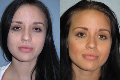Vi Peel - 
	This 24 year old Mexican female Model and facial rejuvenation patient from El Cajon, CA who wanted improvement of her complexion and active mild acne skin condition. Her skin damage resulted from her ongoing acne condition. She wanted to improve her complexion. Recommended a chemical face peel (ViPeel) to best treat her pigmentation problems of her face. Two weeks after her second ViPeel treatment the patient is very happy to see so much improvement. She feels Dr. Stuart Kincaid far exceeded what she thought she would get. From just a chemical peel after previous medical treatment failed to improve her condition.

