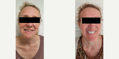45-54 year old woman treated with Smile Makeover, Tooth Repair - Denture: Dentures are prosthetics fabricated by the dentist to replace missing teeth of the patient. They can be made from diverse materials, like thermoplastic or acrylic components for example, and the procedure is really simple. The dentist takes an impression of the patient bite to record the teeth, and with it he or she creates a mold to make a denture piece that can be adjusted to the mouth easily through the gums or the teeth. One perk patients gains from getting dentures is that they are really comfy because they are easy to put it on and off at will.