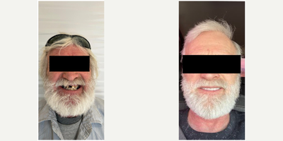 55-64 year old man treated with Smile Makeover, Tooth Repair - Denture: Dentures are prosthetics fabricated by the dentist to replace missing teeth of the patient. They can be made from diverse materials, like thermoplastic or acrylic components for example, and the procedure is really simple. The dentist takes an impression of the patient bite to record the teeth, and with it he or she creates a mold to make a denture piece that can be adjusted to the mouth easily through the gums or the teeth. One perk patients gains from getting dentures is that they are really comfy because they are easy to put it on and off at will.