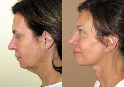Face/neck lift with midface lift - 
	Natural looking combination of the facelift and neck lift with midface lift
