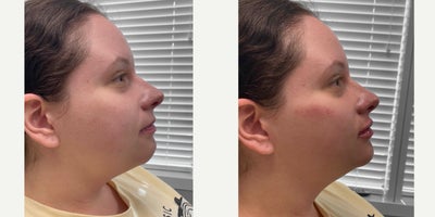 25-34 year old woman treated with Chin Filler - Facial contouring with Dr. Wise: Chin/jawline, cheeks, lips