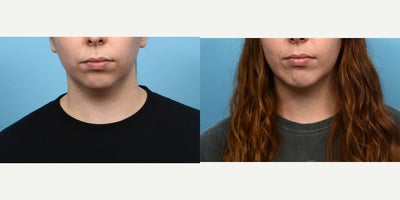 25-34 year old woman treated with Chin Surgery - This 27-year-old patient wanted to subtly enhance the projection of her weak chin, and smooth out her front jawline. Two months after her chin implant surgery, she's happy with the natural and defined appearance Dr. Wise was able to provide her.