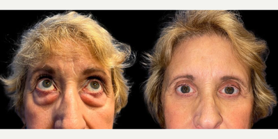 Woman treated with Eyelid Surgery - Transform your gaze. Did you know? Blepharoplasty can be performed on both upper and lower eyelids to reduce puffiness, wrinkles and sagging!