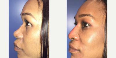 Woman treated with Nonsurgical Nose Job - A Greenberg Liquid Rhinoplasty can non surgically enhance the appearance of your nose using fillers with little to no downtime! Dr. Greenberg restored this beautiful patients bridge to give her the look she wanted.