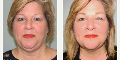 57 year old patient after first Kybella treatment. - This patient is 57 years old.  Significant improvements at her 2 week follow up appointment.  1 vial of Kybella was used and she has 2-3 future treatments planned.