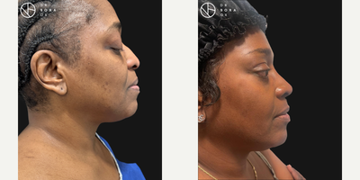45-54 year old woman treated with African American Rhinoplasty, Buccal Fat Removal, Facelift - My patient had Ethnic Rhinoplasty + Chin Liposuction, Buccal Fat Removal and Temporal / Mid Face Lift.