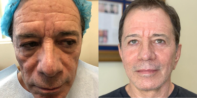 Man treated with Liquid Facelift, Dermal Fillers - I call this combination of lasers, ultrasounds & fillers a  Liquid facelift. No cutting modality was used. Rejuvenate the skin & look younger without cutting surgery.