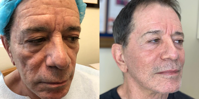 Man treated with Liquid Facelift, Dermal Fillers - I call this combination of lasers, ultrasounds & fillers a  Liquid facelift. No cutting modality was used. Rejuvenate the skin & look younger without cutting surgery.