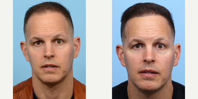 45-54 year old man treated with FUE Hair Transplant, Hair Transplant, Hair Loss Treatment, PRP for Hair Loss, PRP Injections - The 45-year-old individual desired to enhance the density of their hair and reinforce their hairline. Dr. Wise conducted an FUE hair transplant procedure involving 2,050 grafts, along with a single session of PRP therapy with ACell. Results after 9 months post-operation are displayed.