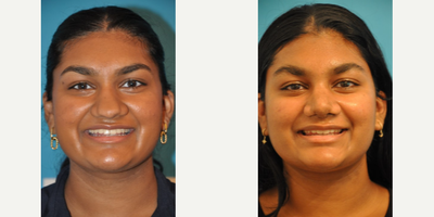 Teenage Rhinoplasty - Teenage Rhinoplasty