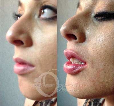 Woman treated with Lip Augmentation - Woman treated with Lip Augmentation.