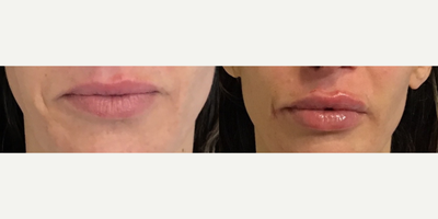 Woman treated with Restylane Kysse, Juvederm, Lip Fillers - Woman treated with Restylane Kysse, Juvederm, Lip Fillers