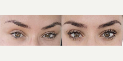 18-24 year old woman treated with Latisse - Consistently treating with Latisse Eyelash Growth Serum over 6 months.