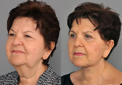 72 year old woman treated with Facelift - 72 year old woman treated with full SMAS Lamellar Facelift