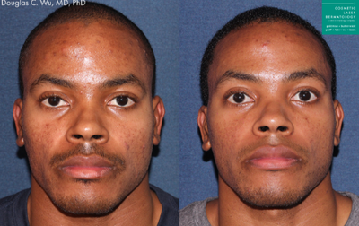 25-34 year old man treated with Intracel - Intracel used to treat acne scarring and hyperpigmentation on a male patient.