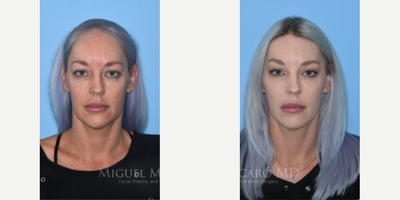 Woman treated with Forehead Reduction - Woman treated with Forehead Reduction and Brow Lift. Patient is shown before and 1 year post-op.