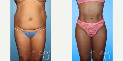 Woman treated with Butt Lift - Woman treated with Natural Butt Lift