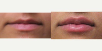 25-34 year old woman treated with Lip Fillers, Juvederm, Restylane, Volbella, Restylane Kysse - Lip augmentation with hyaluronic acid filler (Juvederm, Vollure, Volbella, Voluma, Restylane or Belotero) for balanced natural look & pout