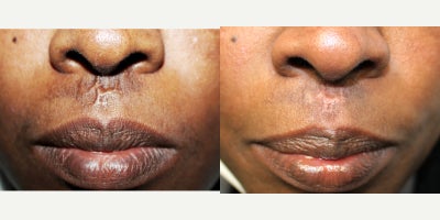 35-44 year old woman treated with UltraClear Laser - Female completed several sessions of the UltraClear laser for scar.