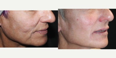 55-64 year old woman treated with UltraClear Laser - Female completed several sessions of the UltraClear.