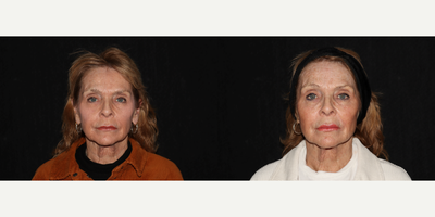 65-74 year old woman treated with Sofwave - Full Face Sofwave, 3 Month Follow Up Photos