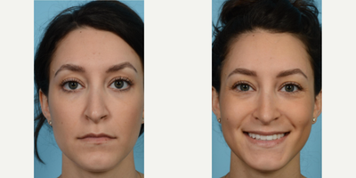 Woman treated with Revision Rhinoplasty - Woman treated with Revision Rhinoplasty