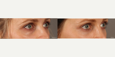 Scarless Lower Bleph (Eyelid Lift) with Fat Transfer and CO2 Laser Resurfacing - This beautiful 31-year-old female struggled with lower lid bags that were worsening with age. A transconjunctival (Scarless) lower lid blepharoplasty was performed to reduce the bags. Finesse multi-level fat transfer was performed to create mid-facial and lower lid contours. Fractional CO2 laser resurfacing was performed to tighten and rejuvenate the skin around the eyes.