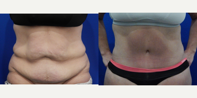 35-44 year old woman treated with Tummy Tuck - This patient had bariatric surgery which resulted in marked weight loss. Her excess skin and fat were treated by a TT.