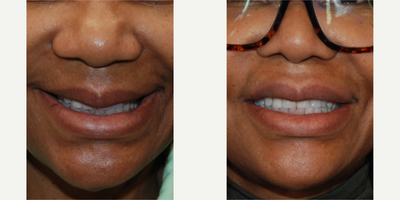 55-64 year old woman treated with Lip Reduction - The aging process also affects the lips, leading to a droopier appearance with time. Our lovely patient was concerned by the overhanging appearance of the central portion of her upper lip especially with smiling. Her after photos are seen very early after a upper lip reduction surgery. All incisions are on the inside of her mouth, and as you can see, there is minimal downtime.