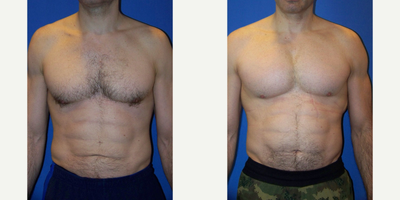 45-54 year old man treated with Pec Implants - 47 year old male 7 months after pec implants performed by Dr Sam Gershenbaum. This patient wanted more projection and fullness to predominantly his upper chest and had vertical rectangular implants placed under the muscle. These particular after photos are one week after exchange of his original implants to a larger size.