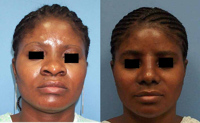 African American Rhinoplasty - This is a 37 year old African American woman who underwent nose job (rhinoplasty) with significant tip work, dorsal graft, and narrowing of the base of the nose.