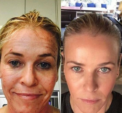 Woman treated with ProFractional Laser - Woman treated with ProFractional Laser