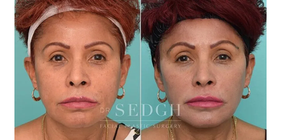 55-64 year old woman treated with Facelift Revision, Mini Facelift, Facial Fat Transfer - This beautiful patient had a previous facelift many years ago, and she was unhappy with some loss of volume in her cheeks, temples and early drooping of her face and neck. A revision mini-facelift with fat grafting was performed to bring years back to her face, yet keeping it very natural for her.