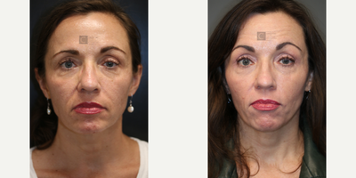 Fractora RF - Laser and Sculptra Combination.