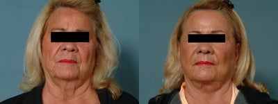 Age: 69 - 	CO2 Laser resurfacing also.