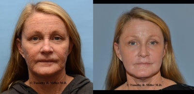 Wrinkle reduction with Ultra Pulse CO2 laser - Very deep lines and wrinkles, with moderate facial tightening after Ultrapulse (Active Fx)  CO2 laser.  Procedure designed and performed by Timothy R. Miller, M.D.