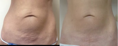 ThermiTight - Before and after photos courtesy of ThermiTight, Karen Harkaway, MD