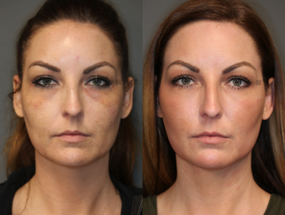 Laser Treatment For Melasma - Laser treatment for melasma with PRP.