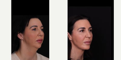 35-44 year old woman treated with Neck Lift, Rhinoplasty, Chin Implant, Facial Fat Transfer - Our patient is 9 months out from a deep neck lift, chin implant, rhinoplasty, and facial fat grafting and she is healing beautifully! Thank you to her for allowing us to share!