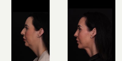 35-44 year old woman treated with Neck Lift, Rhinoplasty, Chin Implant, Facial Fat Transfer - Our patient is 9 months out from a deep neck lift, chin implant, rhinoplasty, and facial fat grafting and she is healing beautifully! Thank you to her for allowing us to share!