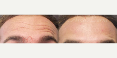 25-34 year old woman treated with Botox, Dysport, Jeuveau, Xeomin - Botox injection for treatment of lines and wrinkles in forehead and frown lines (can also be done with Dysport, Jeuveau or Xeomin)