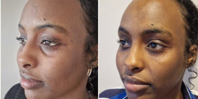 25-34 year old woman treated with Dermal Fillers under the Eyes - Our lovely patient was happy to share her results of her hollow under eyes and dark circle treatment  2 weeks after the therapy with a little bit of hyaluronic acid fillers: for a fresh, more youthful, and well-rested look!