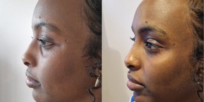 25-34 year old woman treated with Dermal Fillers under the Eyes - Our lovely patient was happy to share her results of her hollow under eyes and dark circle treatment  2 weeks after the therapy with a little bit of hyaluronic acid fillers: for a fresh, more youthful, and well-rested look!