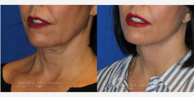 55-64 year old woman treated with Facelift, Chin Liposuction, Restylane - Patient had Facelift, submental liposuction, Restylane 1ml perioral.