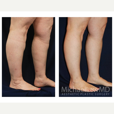 55-64 year old woman treated with Calf Reduction - Lower Leg Liposuction