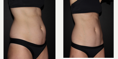 25-34 year old woman treated with UltraShape Power - Ultrashape and Velashape